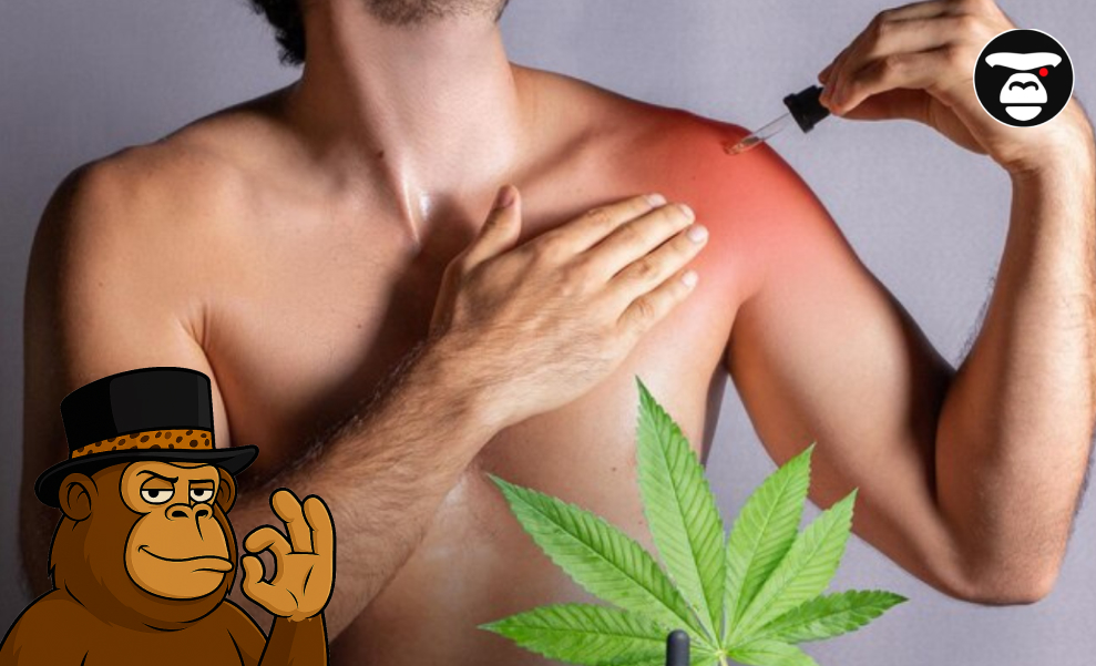 Close-up of a person applying oil, likely CBD or hemp, with a dropper to a severely sunburned, red shoulder.